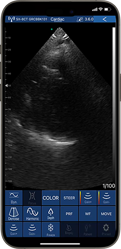 Real-time cardiology ultrasound imaging of anatomical structure on phone