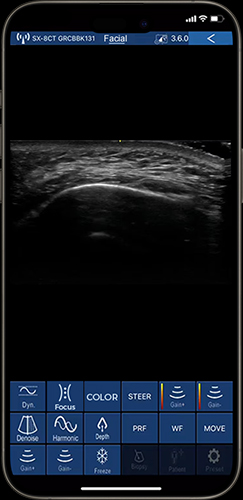 Real-time guidance for facial injection on phone with plastic surgery ultrasound