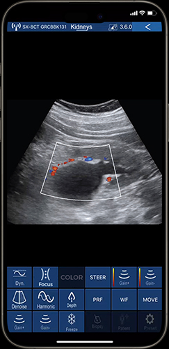 Real-time abdominal organ imaging with 80 elements ultrasound transducer
