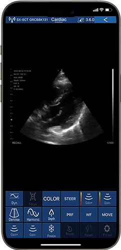Real-time emergency ultrasound imaging of echocardiography evaluation on phone