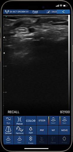 musculoskeletal ultrasound image on phone using linear probe ultrasound