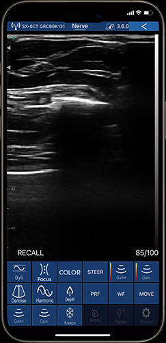 neurological ultrasound image on phone with curvilinear probe ultrasound