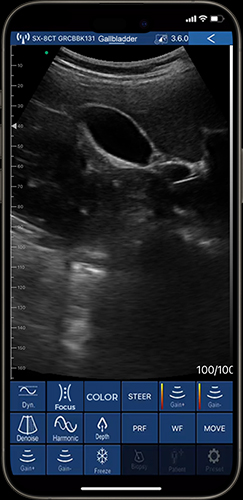 Real-time emergency ultrasound imaging for rapid abdominal pain diagnosis on phone