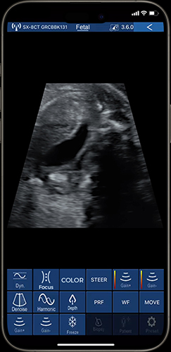 Real-time obstetric imaging with 80 elements ultrasound transducer