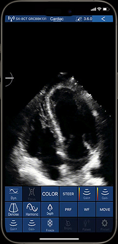Doppler echocardiography shown on phone