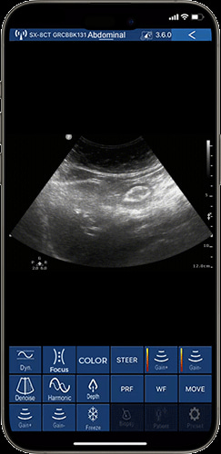 Real-time gastrointestinal assessment on phone using internal medicine ultrasound