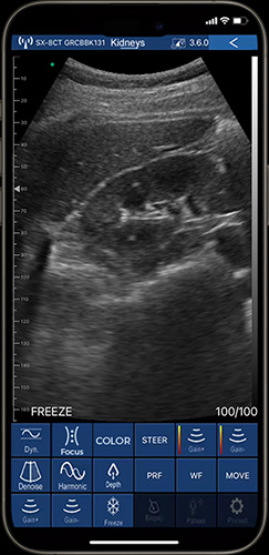 Real-time kidney evaluation on phone using internal medicine ultrasound