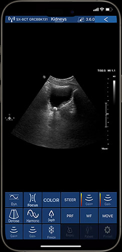 Renal ultrasonography on phone with color Doppler ultrasound