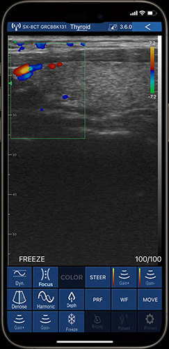Real-time thyroid evaluation on phone using internal medicine ultrasound