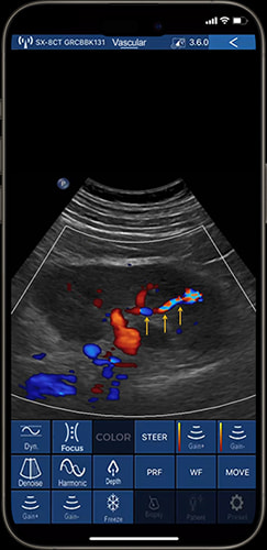 vascular ultrasonography on phone with color Doppler ultrasound