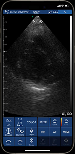 Real-time vessel imaging on phone with advanced 192 elements ultrasound
