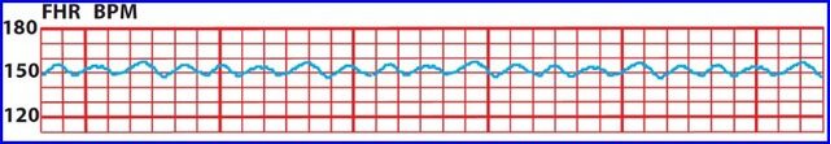 Fetal Heart Rate Baseline