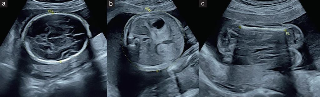 Standard fetal biometry