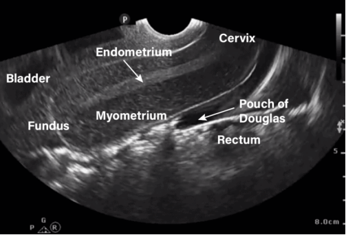 Transvaginal ultrasound with free fluid in pouch of douglas