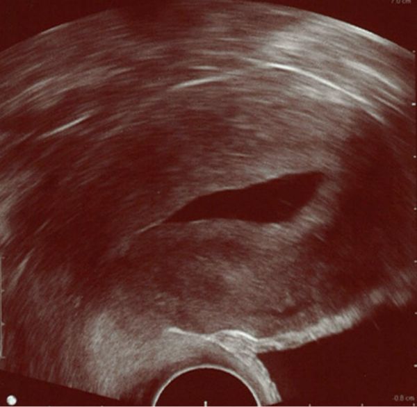 Cervix Fluid Ultrasound