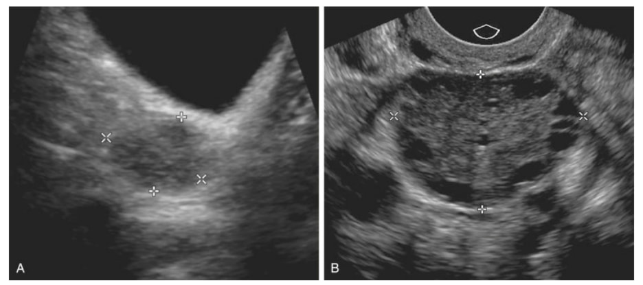 pic of ultrasound for ovaries