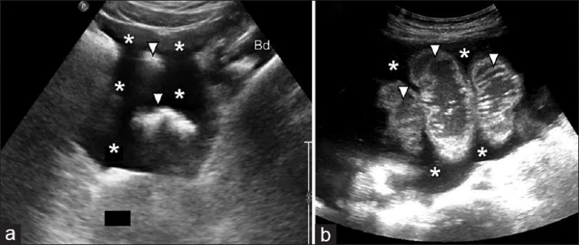 Pelvic FAST positive views from different patients: (a) sagittal; (b) axial.