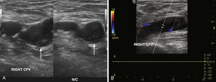 Acute Thrombus DVT Ultrasound Imaging