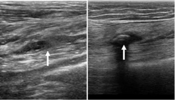 Chronic Thrombus DVT Ultrasound Imaging