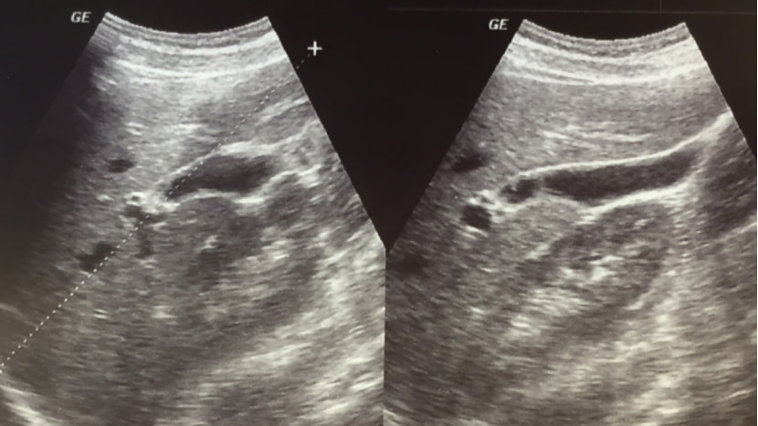 An ultrasound scan of the liver and gallbladder