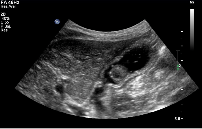 Gastric Ultrasound Showing Polypoid Tumor in Stomach