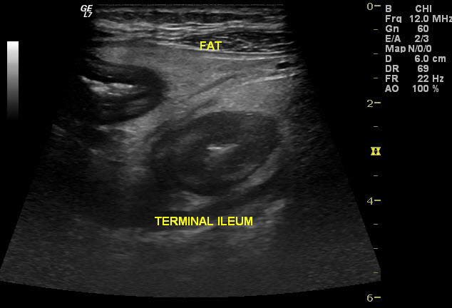 Crohn's Disease Ultrasound Imaging: The terminal ileum is thickened