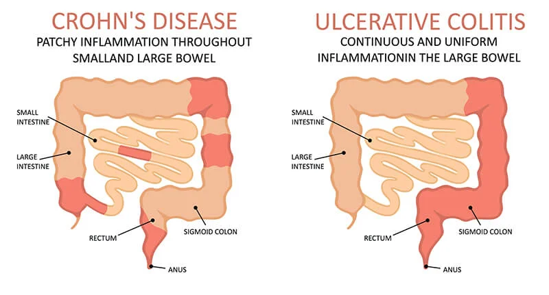 The Contrast Between Crohn's Disease and Ulcerative Colitis
