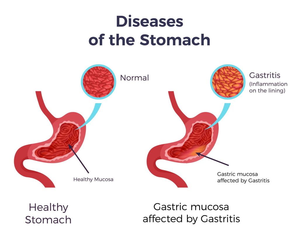 Diseases of the stomach